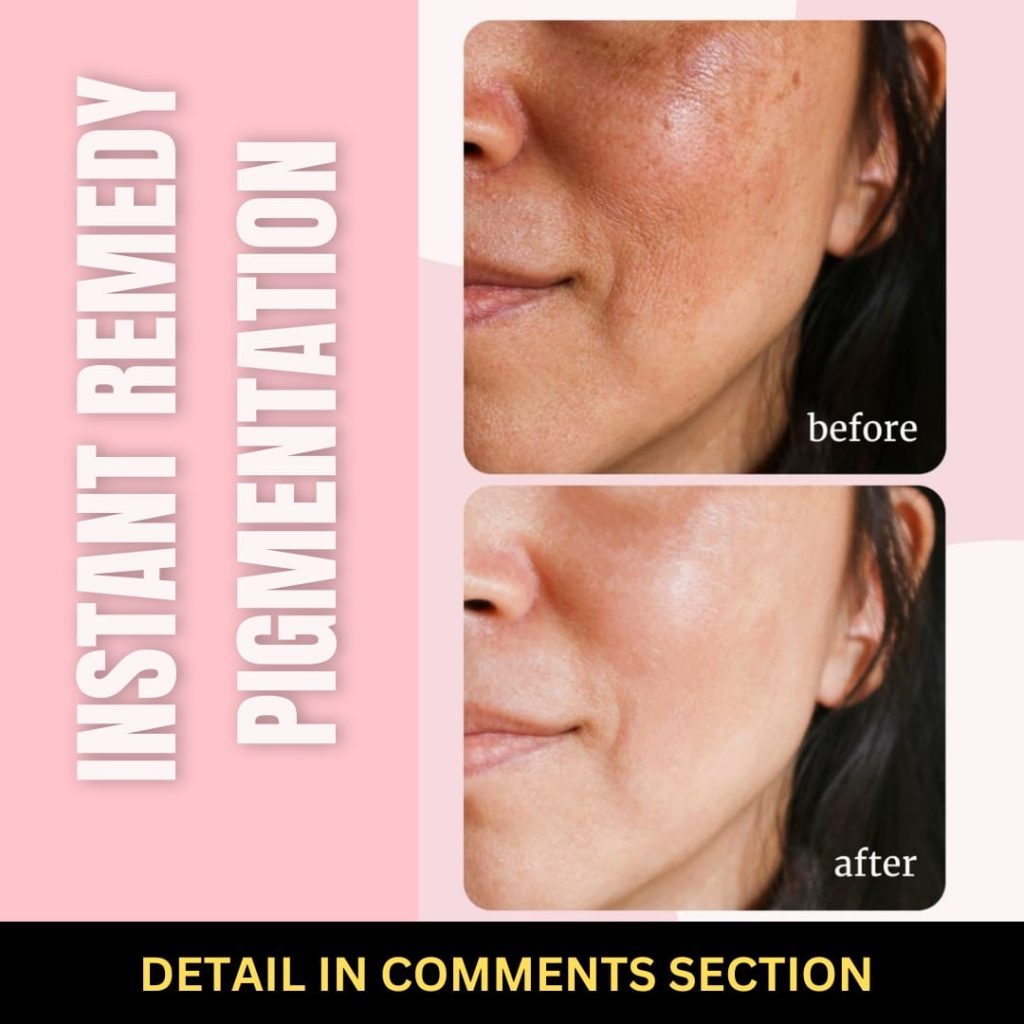 Instant Remedies for Pigmentation Home Solutions for Every Skin Type