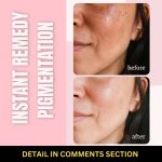 Instant Remedies for Pigmentation Home Solutions for Every Skin Type