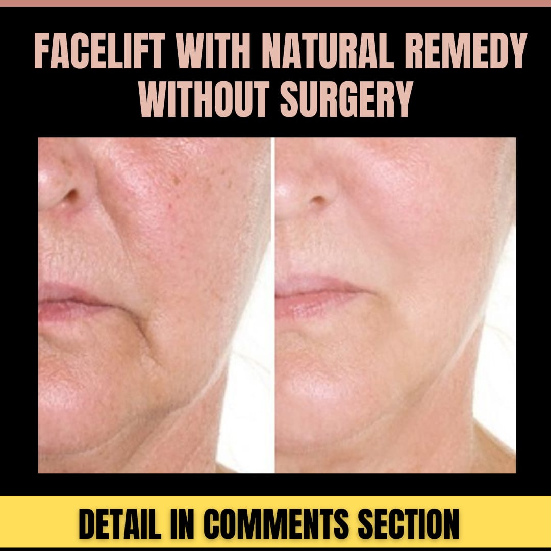 Natural Face Lift Remedies Achieve A Youthful Look Without Surgery V