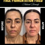 Natural Home Remedies for Face Pigmentation