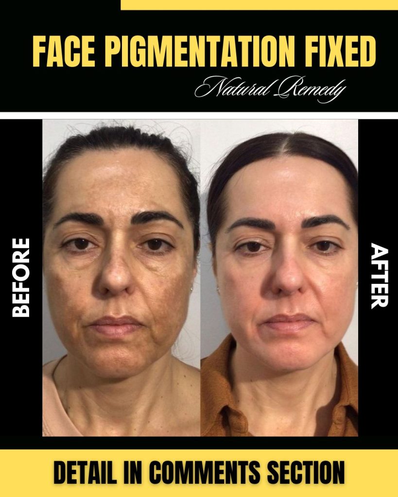 Natural Home Remedies for Face Pigmentation