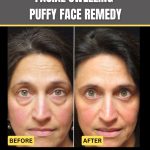 Natural Home Remedies for Facial Swelling and Puffy Face