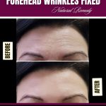 Natural Remedies for Forehead Wrinkles Using Kitchen Ingredients