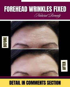 Natural Remedies for Forehead Wrinkles Using Kitchen Ingredients