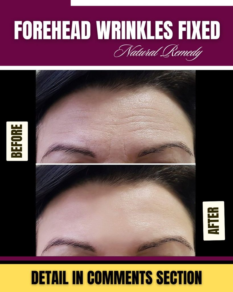 Natural Remedies for Forehead Wrinkles Using Kitchen Ingredients
