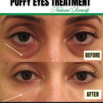 Natural Remedies for Puffy Eyes Effective Solutions for All Skin Types