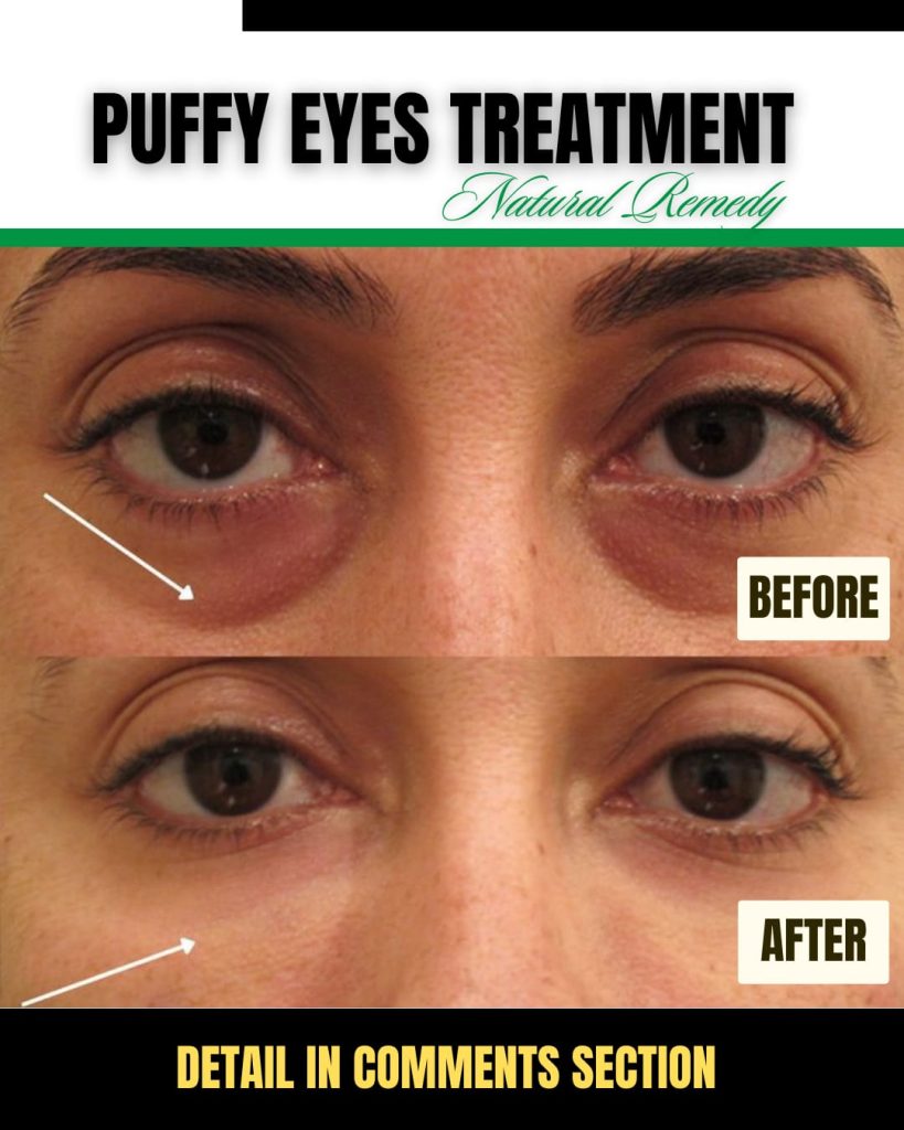 Natural Remedies for Puffy Eyes Effective Solutions for All Skin Types