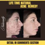 Lifetime Natural Acne Remedies for All Skin Types