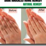 Home Remedies for Dark Knuckles: Natural Solutions for Even Skin Tone