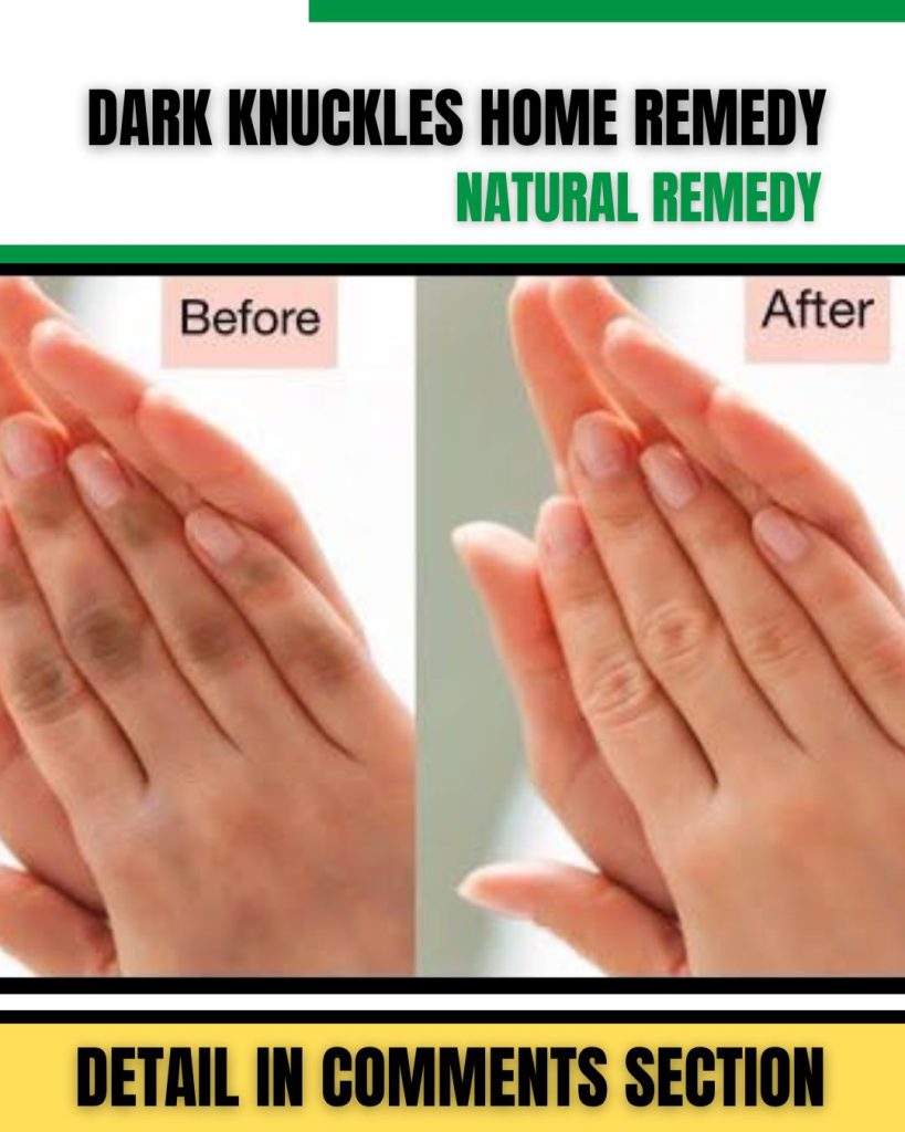 Home Remedies for Dark Knuckles: Natural Solutions for Even Skin Tone