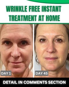 Wrinkle-Free Instant Treatment at Home Home Remedies for All Skin Types