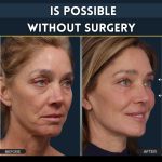 Wrinkle Treatment Without Surgery Effective Home Remedies for All Skin Types