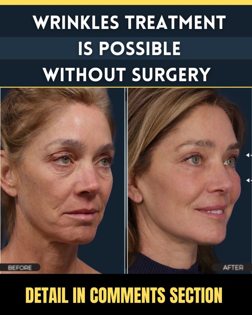 Wrinkle Treatment Without Surgery Effective Home Remedies for All Skin Types
