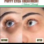 dark circles