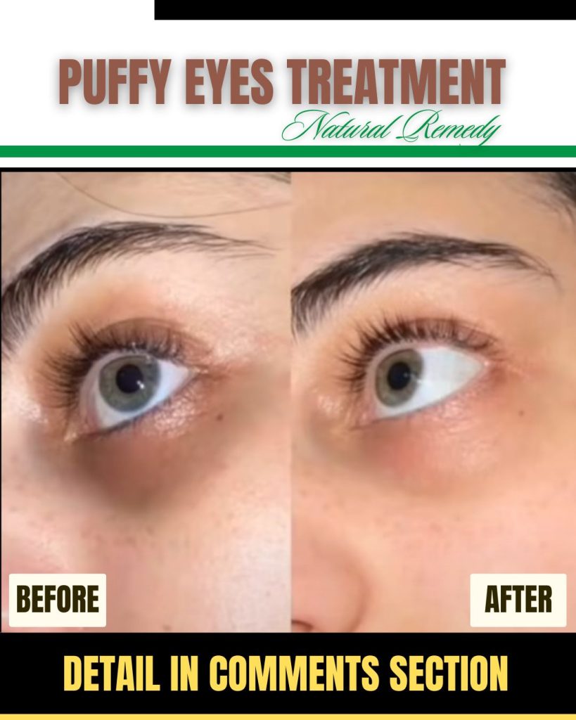 dark circles