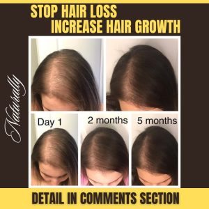 Home Remedies to Stop Hair Loss and Promote Hair Growth