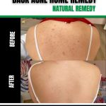 Ancient Remedies for Back Acne Time-Honored Solutions for Clear Skin