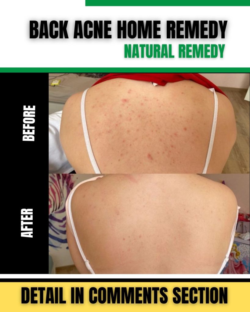 Ancient Remedies for Back Acne Time-Honored Solutions for Clear Skin