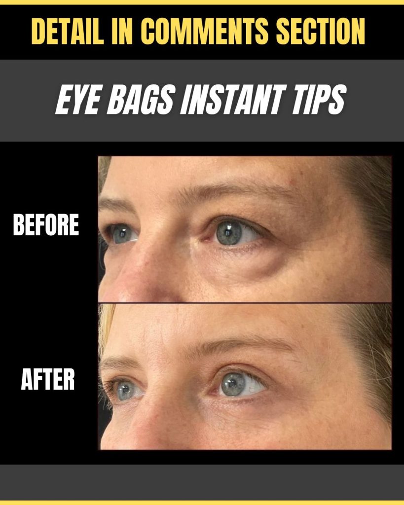 Effective Home Remedies to Instantly Reduce Eye Bags