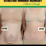 Home Remedies for Body Stretch Marks