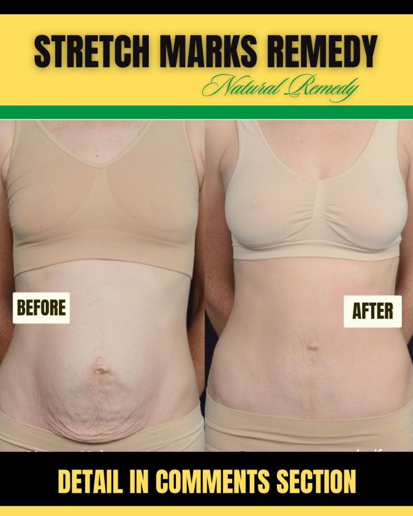 Home Remedies for Body Stretch Marks