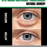 Home Remedies for Eye Bags Natural Treatment