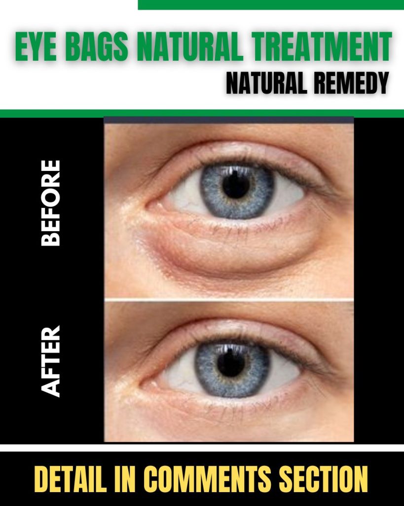 Home Remedies for Eye Bags Natural Treatment