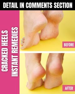 Instant Remedies for Cracked Heels: Home Remedies for Smooth Feet