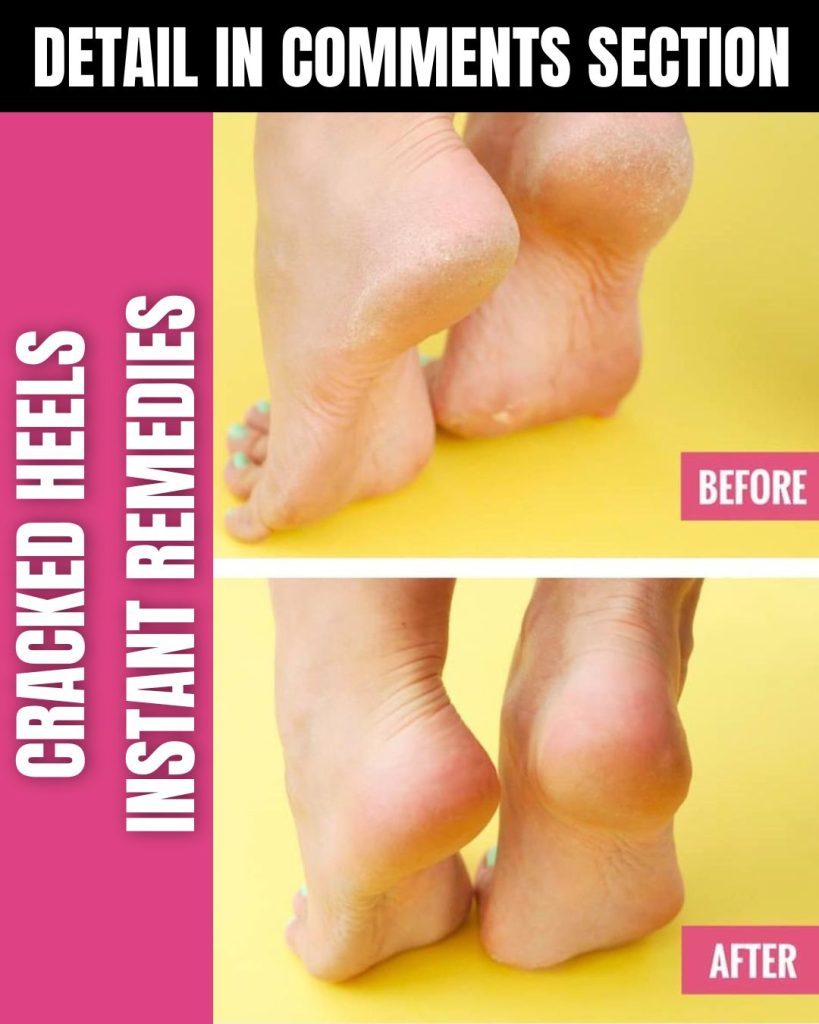 Instant Remedies for Cracked Heels: Home Remedies for Smooth Feet