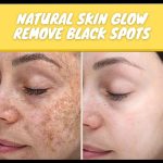 Natural Remedies to Remove Black Spots and Achieve a Natural Glow