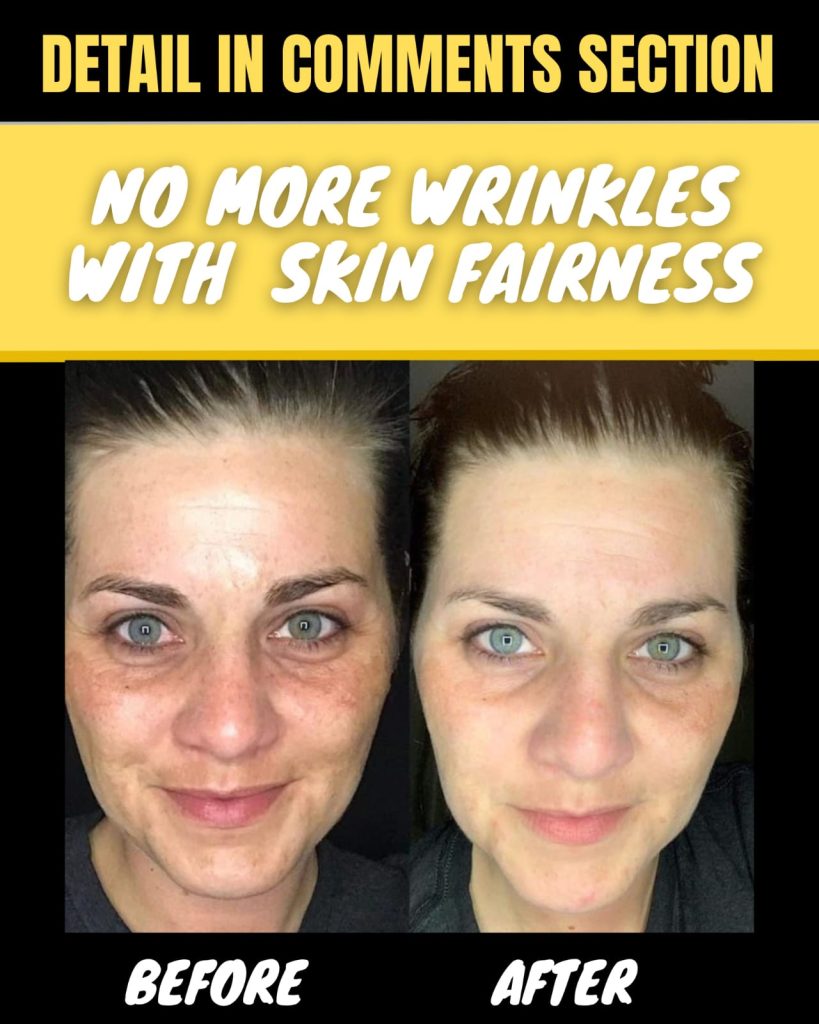 No More Wrinkles with Skin Fairness Effective Home Remedies for Every Skin Type