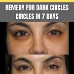 Remove Dark Circles in 7 Days Effective Home Remedies
