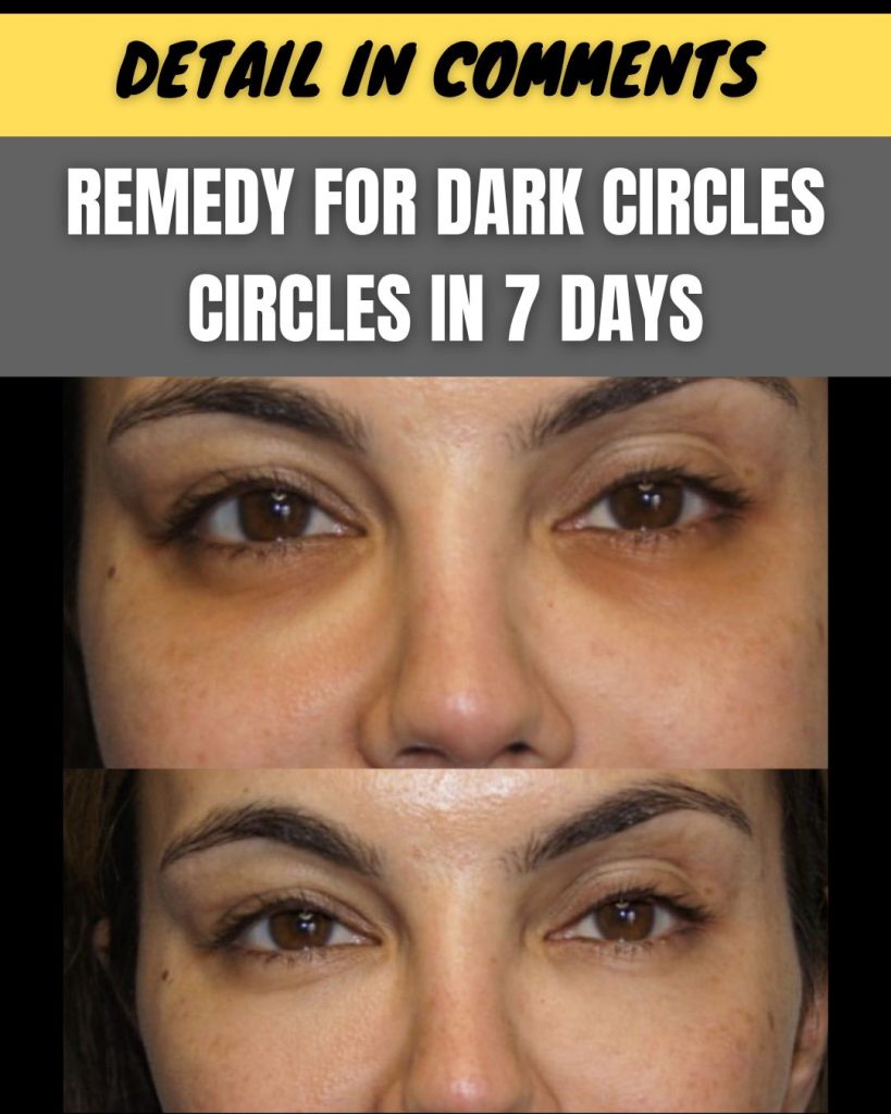 Remove Dark Circles in 7 Days Effective Home Remedies