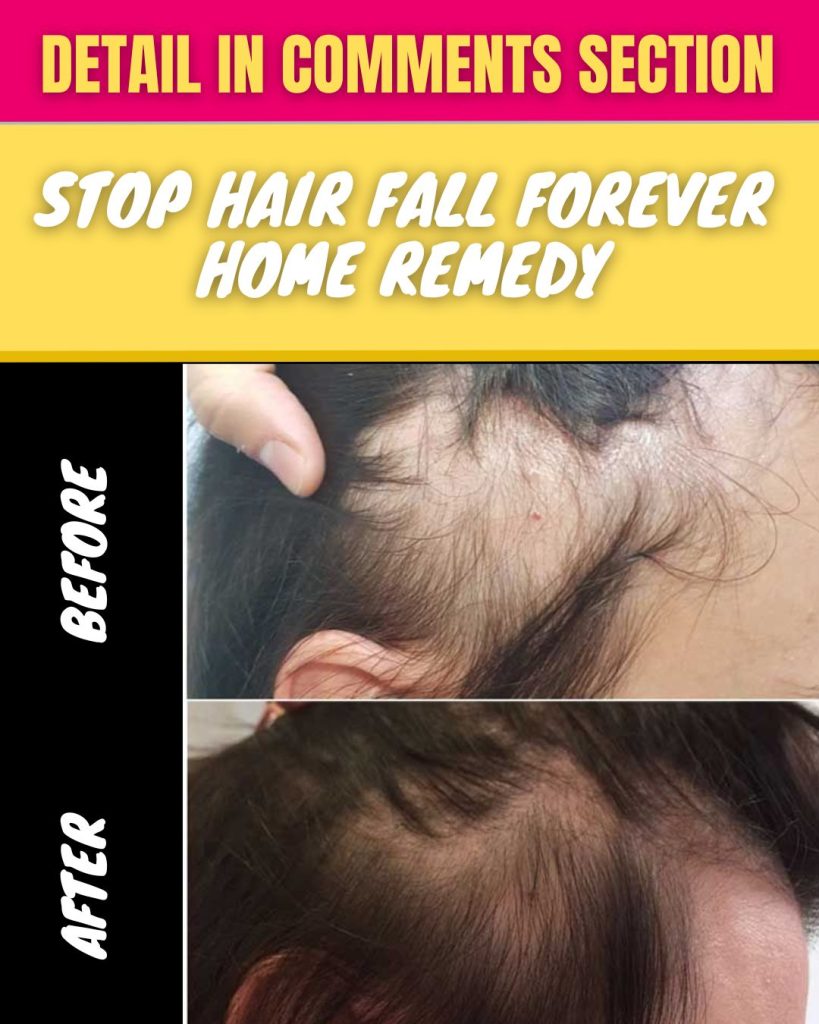 STOP HAIR FALL FOREVER HOME REMEDY