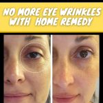 No More Eye Wrinkles Effective Home Remedies by Skin Type