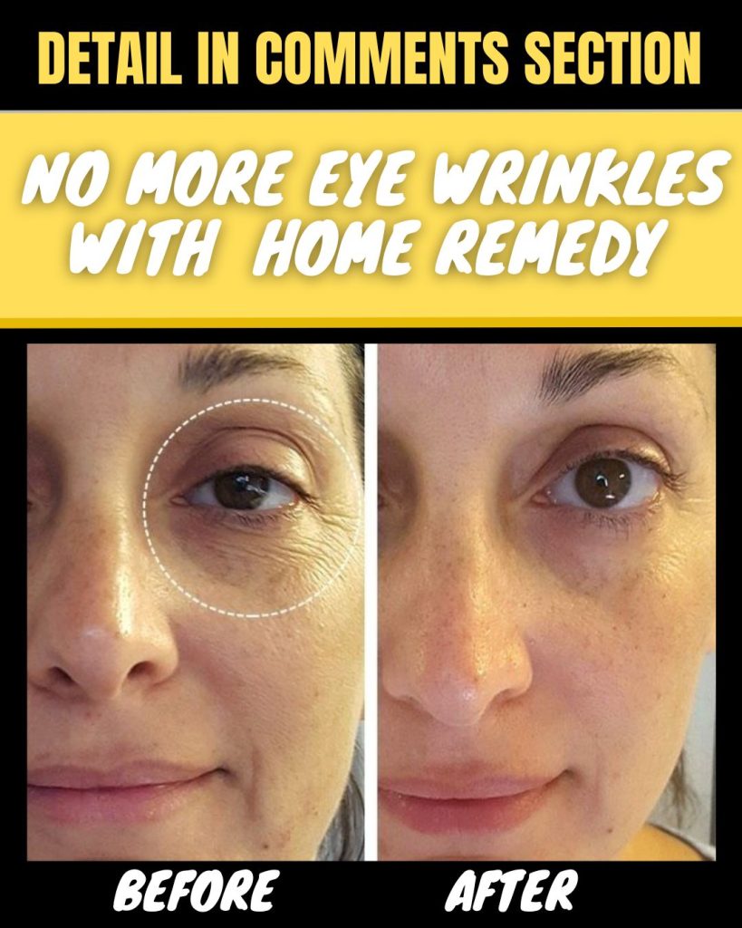 No More Eye Wrinkles Effective Home Remedies by Skin Type