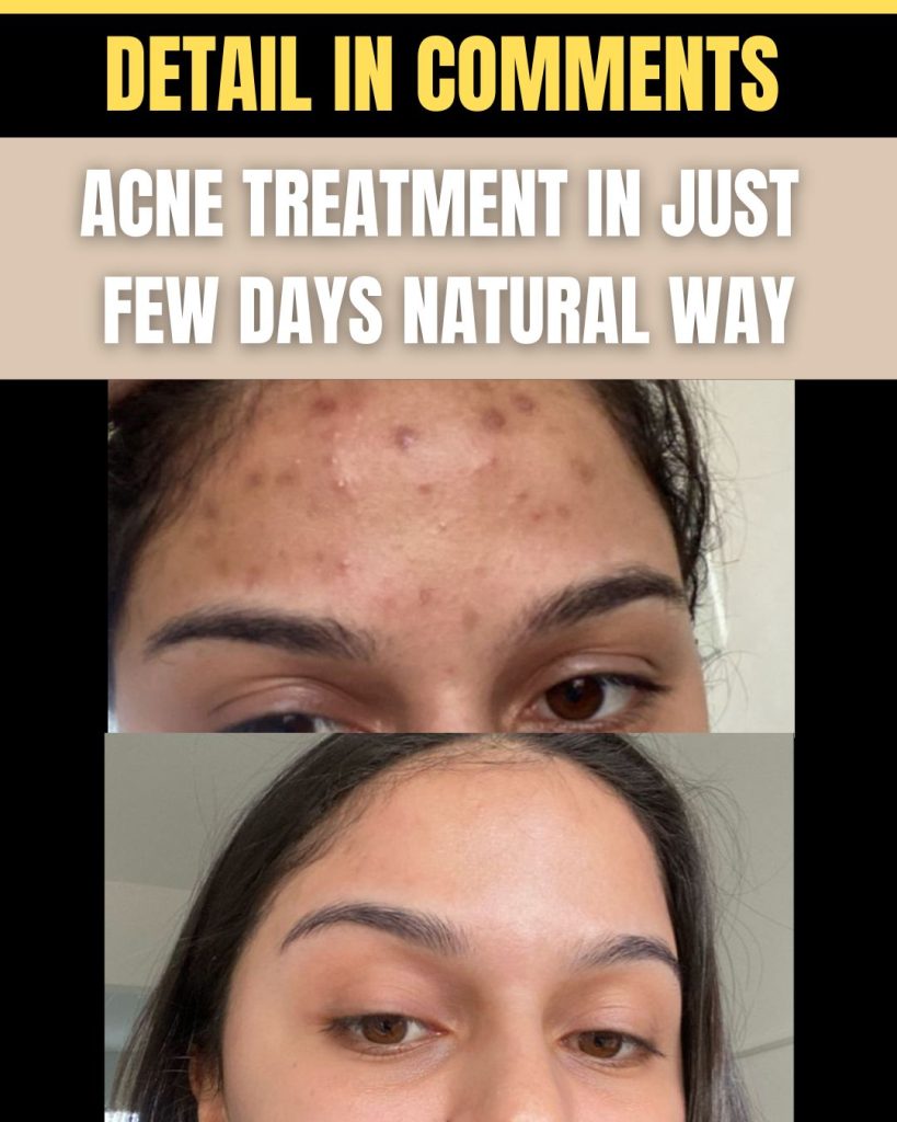 acne cleaning
