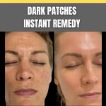DARK PATCHES INSTANT REMEDY