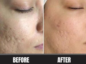 open pores home remedy