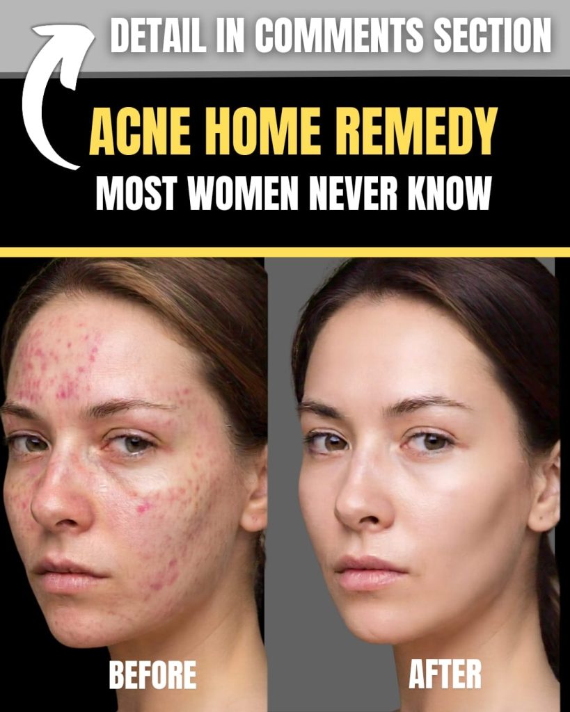 acne remedy