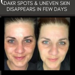 DAKR SPOTS & UNEVEN SKIN DISAPPEARS IN FEW DAYS