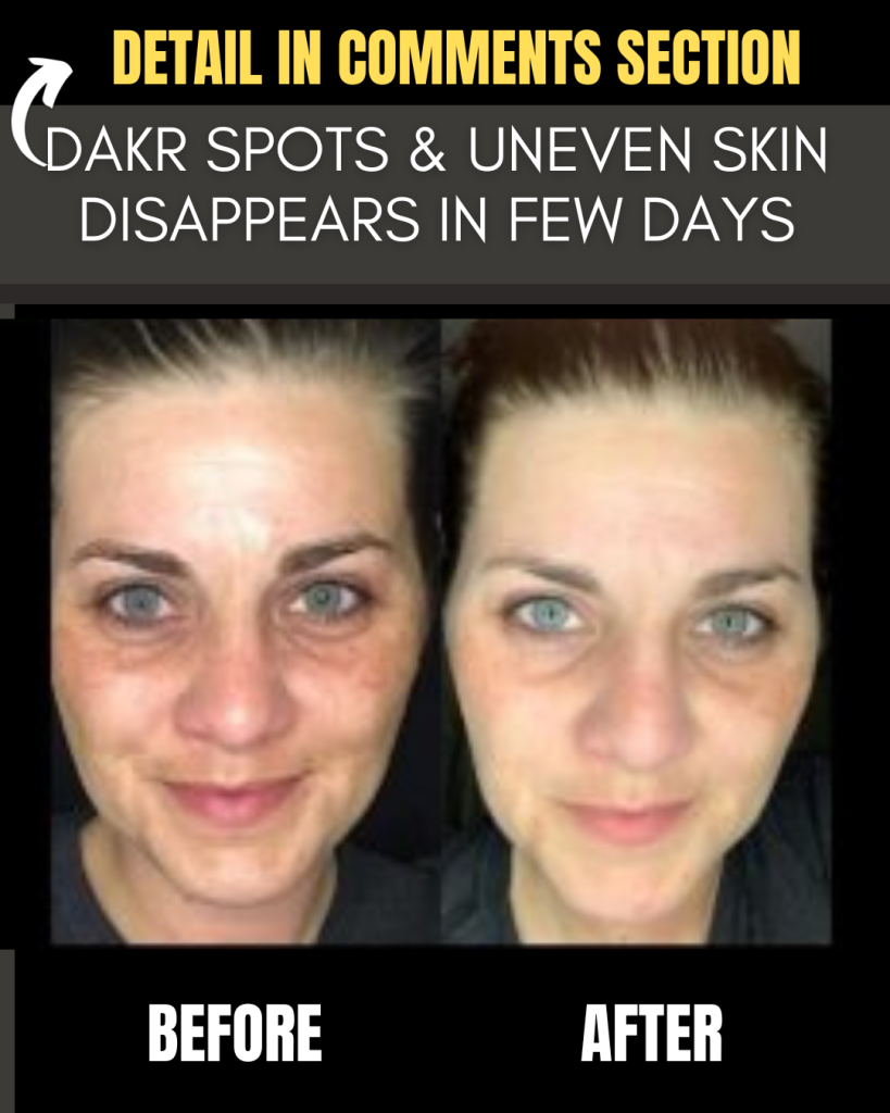 DAKR SPOTS & UNEVEN SKIN DISAPPEARS IN FEW DAYS