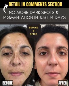 No More Dark Spots and Pigmentation in Just 14 Days Natural Remedies for Every Skin Type