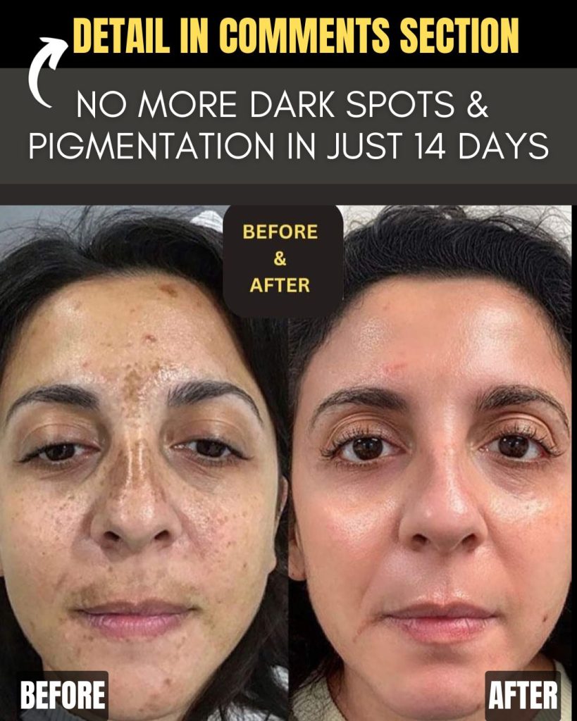 No More Dark Spots and Pigmentation in Just 14 Days Natural Remedies for Every Skin Type