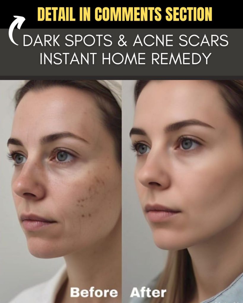 Dark Spots and Acne Scars Instant Home Remedy Ancient Solutions