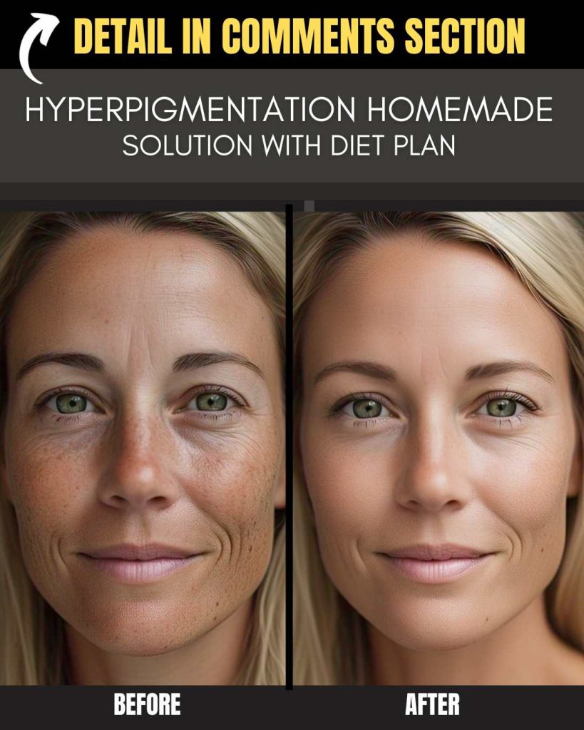 HYPERPIGMENTATION HOMEMADE SOLUTION WITH DIET PLAN