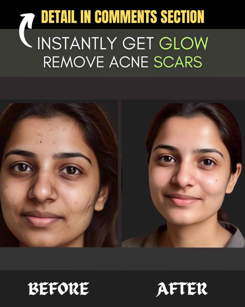 Instant Home Remedies for Radiant Glow & Acne Scar Removal