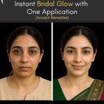 Bridal Glow with Significant Improvement After One Application