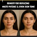 White patches (leucoderma or vitiligo) and uneven skin tone are common concerns for many people. Factors such as vitamin deficiencies, hormonal imbalance, fungal infections, and excessive sun exposure can trigger these issues.