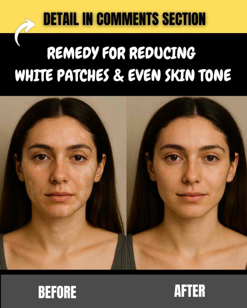 White patches (leucoderma or vitiligo) and uneven skin tone are common concerns for many people. Factors such as vitamin deficiencies, hormonal imbalance, fungal infections, and excessive sun exposure can trigger these issues.
